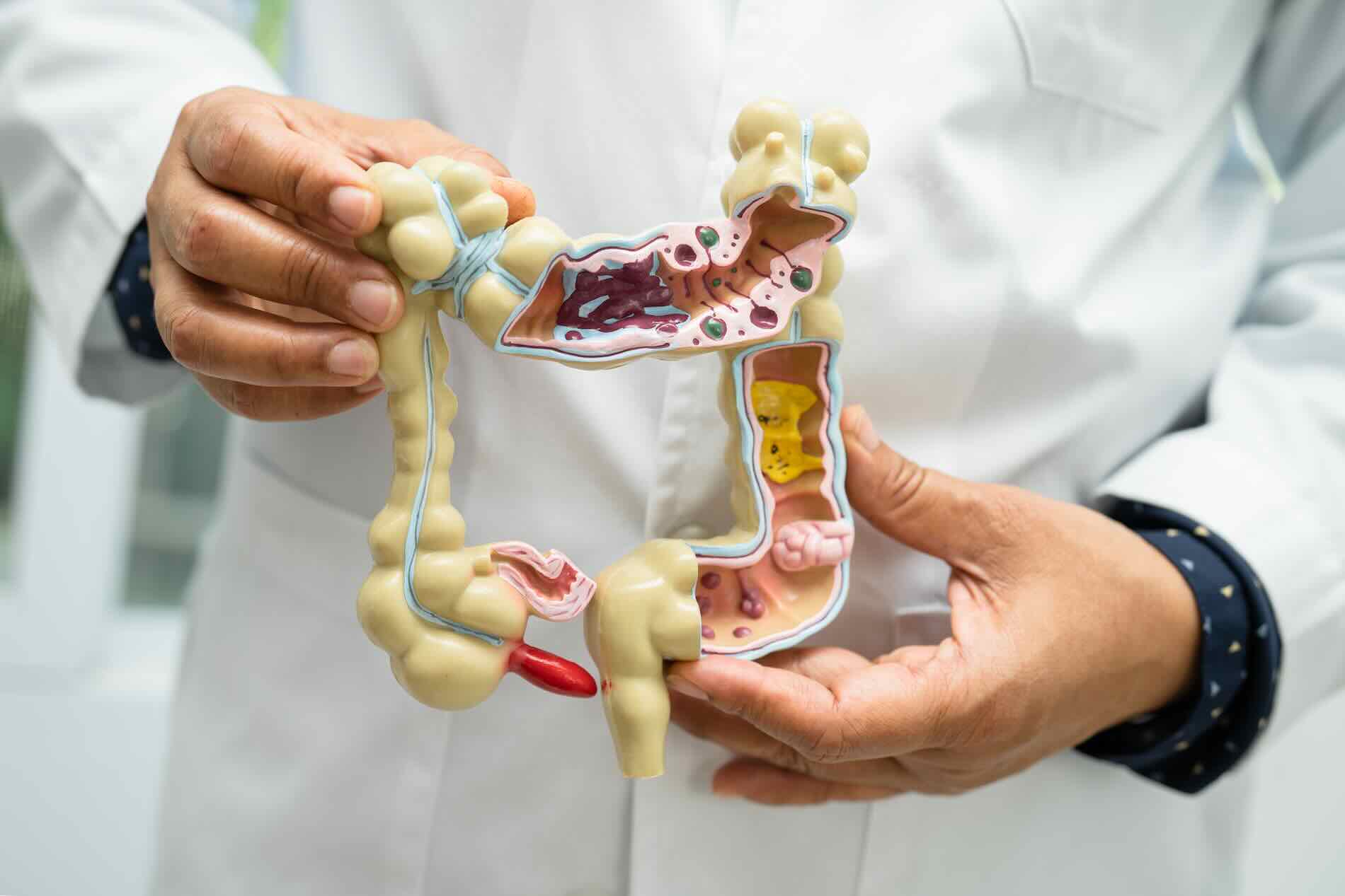 Gut Microbiome and Cancer